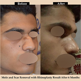 rhinoplasty-img1